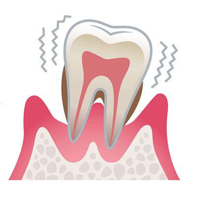 歯周病 重度